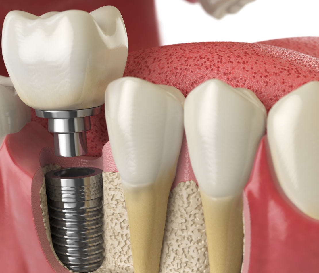 Conoce nuestro servicio de implantes dentales