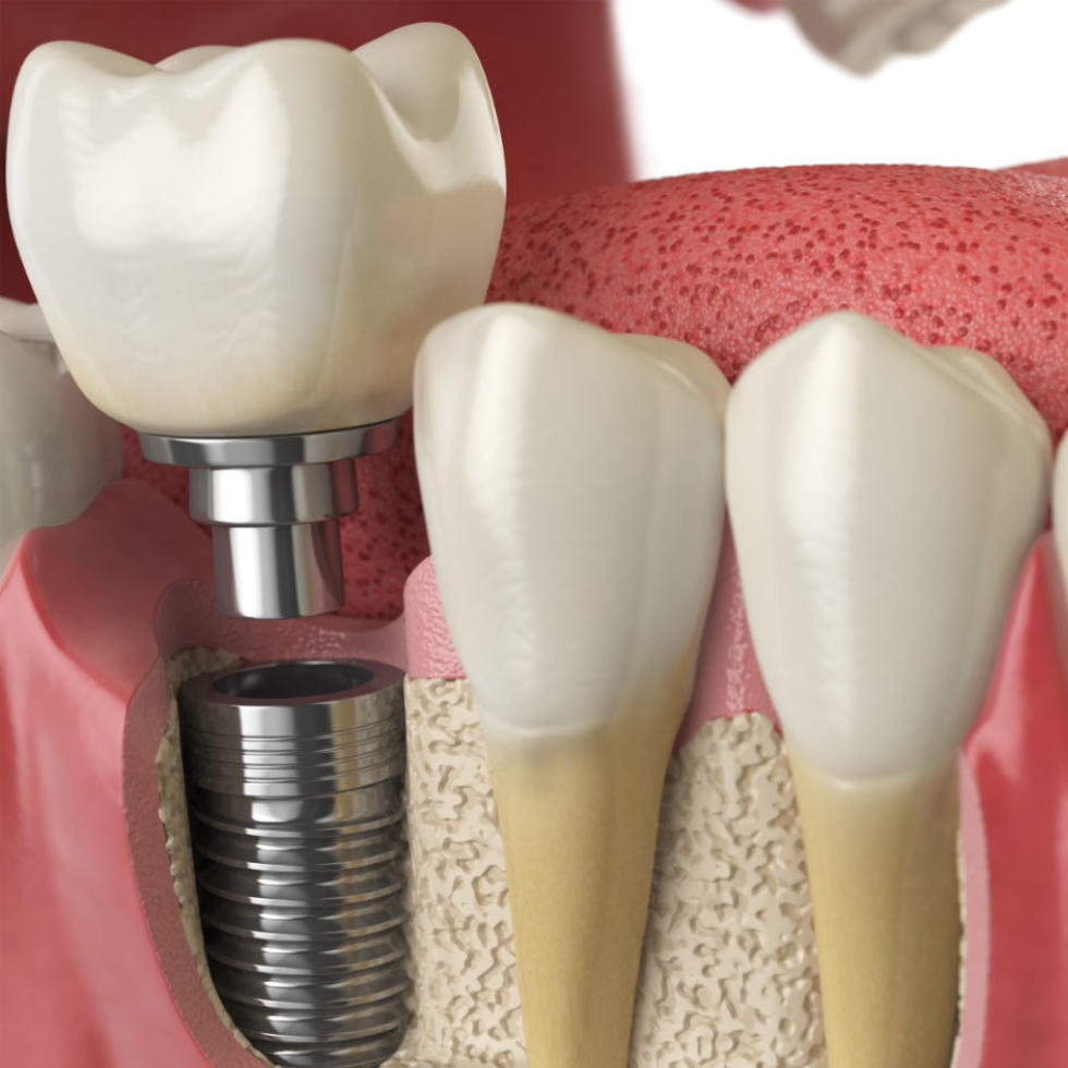 Todo lo que necesitas saber sobre los implantes dentales