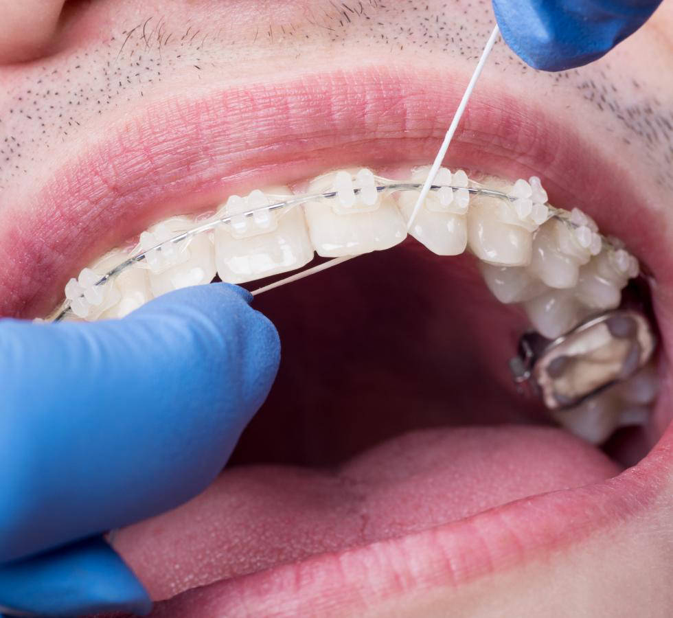 Tipos de Ortodoncia