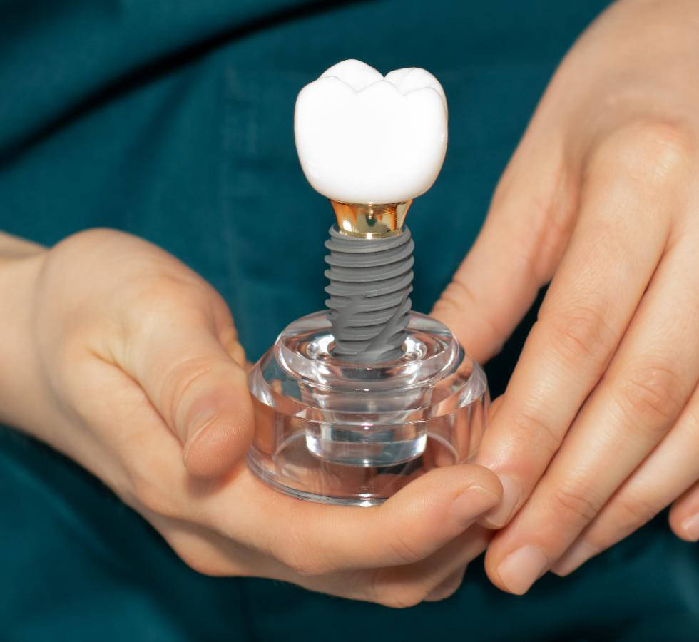 ¿Cómo saber si soy candidato a implantes dentales?