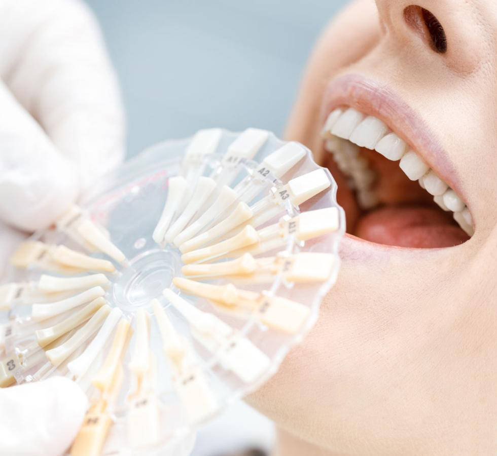 Aclaramiento dental.